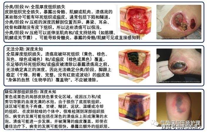 壓瘡最新分期與護理方法詳解