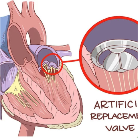 最新瓣膜技術(shù)重塑心臟未來健康之路